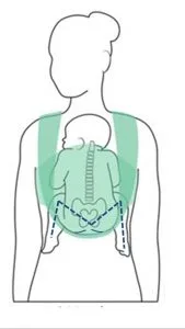 Hip Dysplasia Are Baby Carriers Good with Hip Dysplasia? 2 Things to Look for Hip Healthy Babywearing!