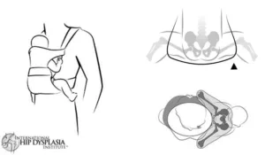Hip Dysplasia